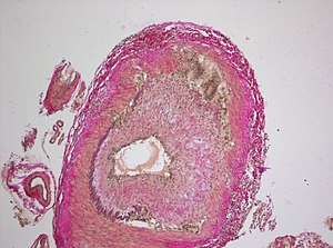 Cerebral Giant-Cell Vasculitis.jpg