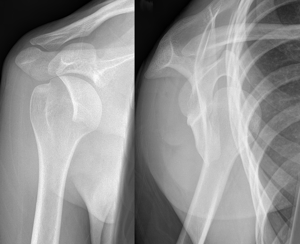 1024px-Dislocated_shoulder_X-ray_05