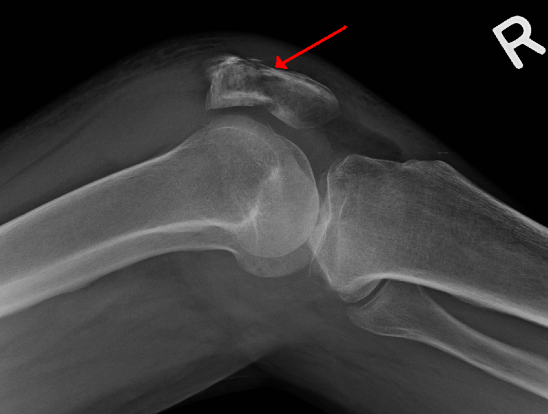 Patella fracture