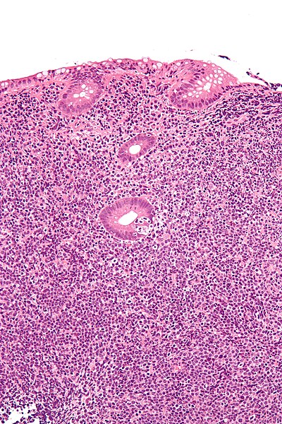 File:Gastrointestinal lymphoepithelial lesion - high mag.jpg