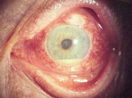 Uveitis