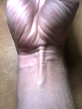 Thumbnail for Palmaris longus muscle