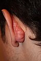 Posterior auricular Keloid triggered by otoplasty surgery.