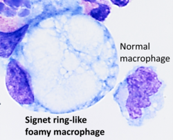 Signet ring-like foamy macrophage.png