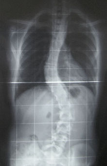 צילום רנטגן של עקמת חמורה