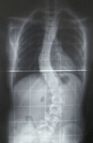 Preoperative (left) and postoperative (right) X-ray of a person with scoliosis