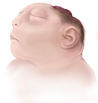 <span class="mw-page-title-main">Anencephaly</span> Neural tube defect involving absence of much of the brain, skull and scalp