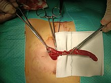 Inflamed appendix removal by open surgery Apendixexternalview.jpg