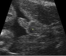 midwife dating ultrasound pik dating
