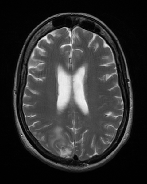 File:BrainToxoplasmosis MRI 4 08.png