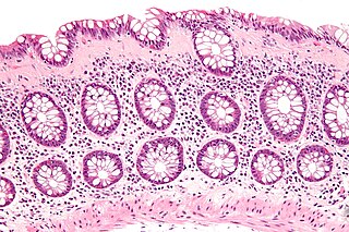 Collagenous colitis colitis characterized by a distinctive thickening of the subepithelial collagen table