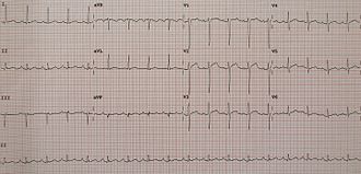 An example of mildly elevated ST segments in V1 to V3 that are concave down ConcaveDown.jpg