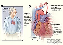 Shows a cartoon diagram of the human heart, showing the newly grafted Saphenous Vein following vascular surgery.