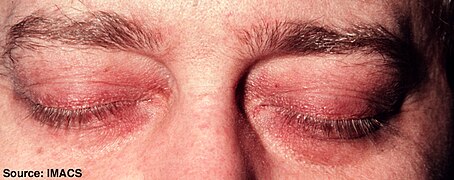 Dermatomyositis Wikipedia