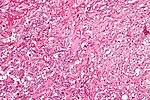 Thumbnail for Gangliocytic paraganglioma