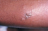 Gonococcal lesion on the skin PHIL 2038 lores.jpg