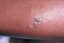 Gonococcal lesion on the skin PHIL 2038 lores.jpg