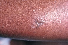 Gonococcal lesion on the skin PHIL 2038 lores.jpg