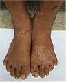 Large, hypopigmented patches topped with scaly pink and brown papules on the dorsa of feet and ankles.jpg