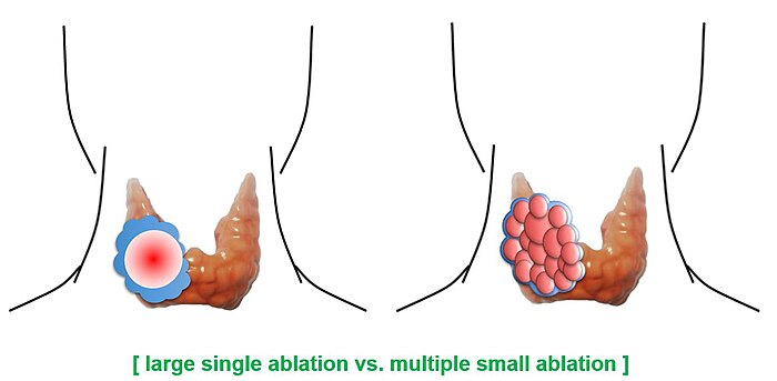 Large vs multiple ablation