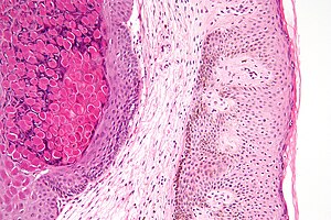 Molluscum contagiosum high mag.jpg