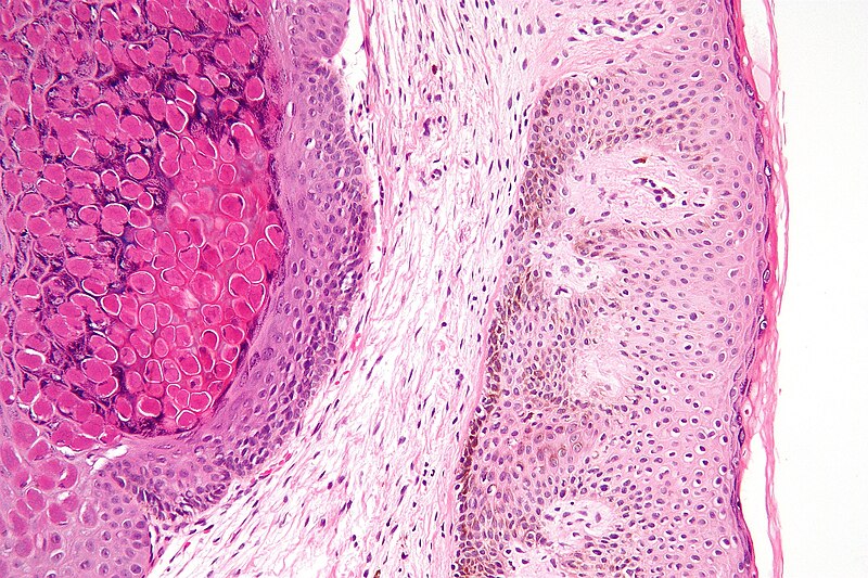 File:Molluscum contagiosum high mag.jpg