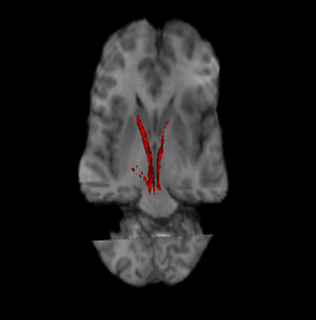 Nigrostriatal pathway