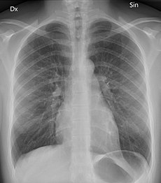 Normal posteroanterior (PA) chest radiograph (X-ray).jpg