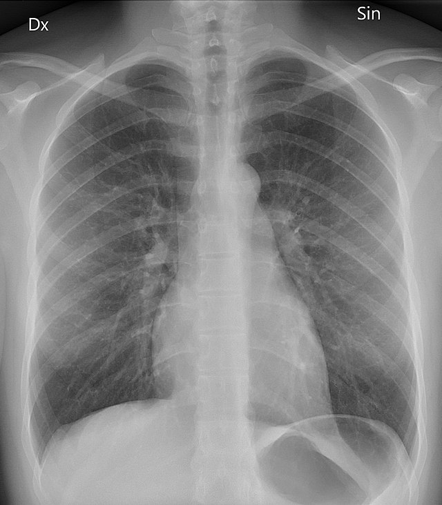 Small And Narrow Chest, Spot Diagnosis