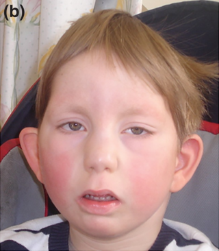 <span class="mw-page-title-main">Okamoto syndrome</span> Rare genetic condition involving urinary, heart, facial and neurological features