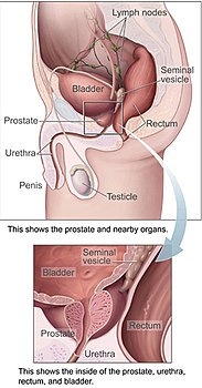 Prostatelead.jpg