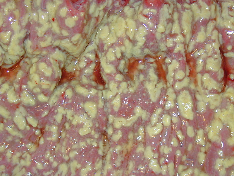 ملف:Pseudomembranous colitis.JPG