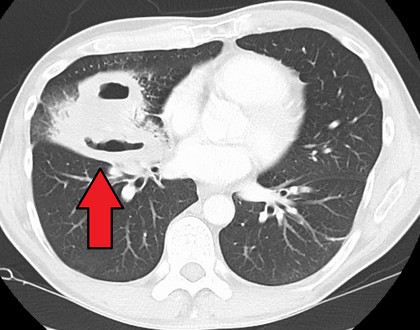 Pulmonary abscess on CT scan
