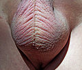 The seam or mid-line on the scrotum is called the raphe.
