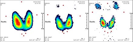 Radiothérapie à l'iode 131 — Wikipédia