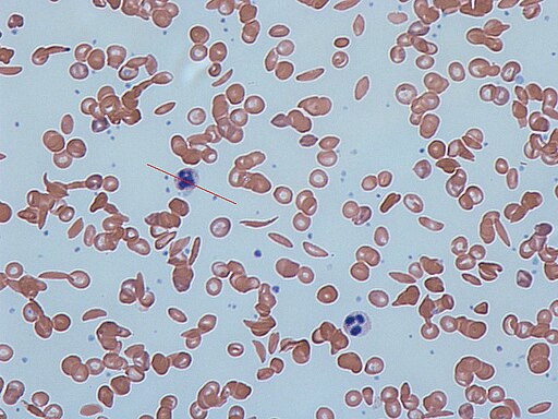 Sickle cells