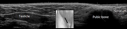 Ultrasonography of cryptorchidism - annotated.jpg