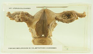 Utérus-Col-Ovaire Fibromyomes-intra-muraux 55-o.apatho-1471a-utecolova.jpg