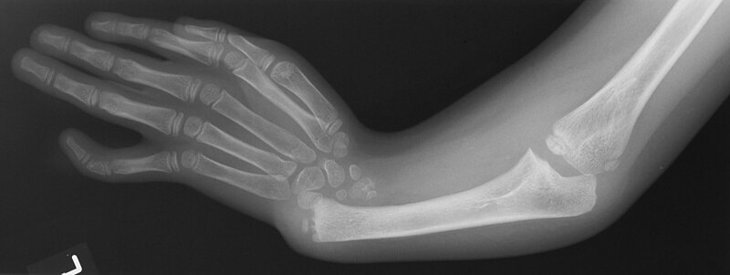 File:X-ray of arm showing absent radius and radially deviated hand, caused by Thrombocytopenia and Absent Radius syndrome.jpg