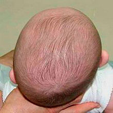 Head of plagiocephalic baby viewed from above Plagiotsefaliia.jpg