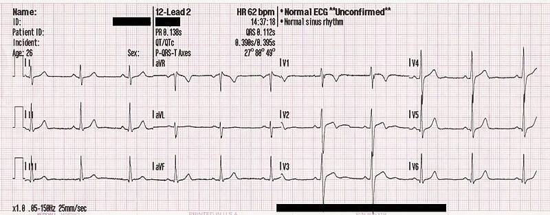 File:12 lead ECG of a 26 year old male.jpg