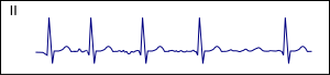 Afib small (CardioNetworks ECGpedia).svg