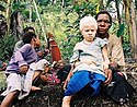 Африканская девочка — альбинос
