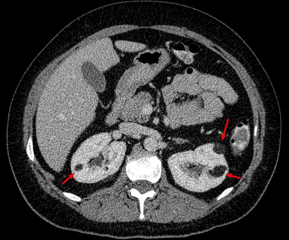 A CT of the kidneys
