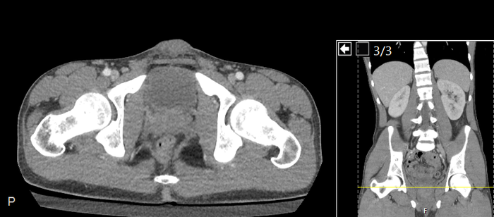 CT of a normal abdomen and pelvis, axial plane 265.png