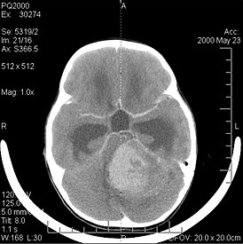 Computertomografie van het hoofd van een patiënt met medulloblastoom