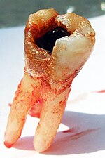Thumbnail for Tooth pathology