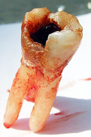 Dental cavity2.jpg