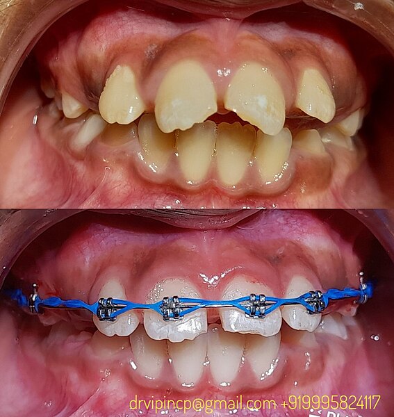 File:Edge wise brackets for retraction of protruded teeth.jpg