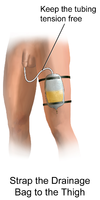Foley Catheter Drainage Illustration